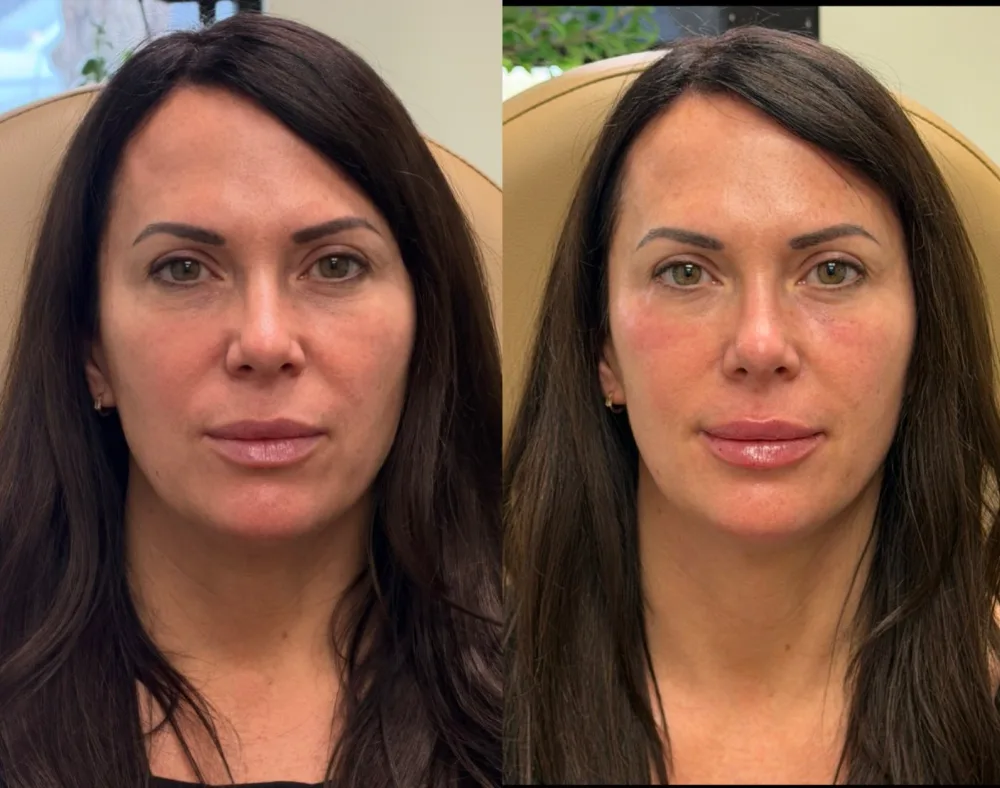 Before and after result following injectable treatment at The Aesthetic Company, Canton MI