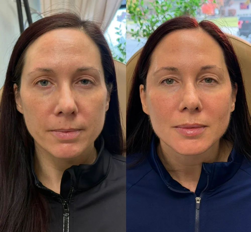 Before and after result following skin rejuvenation at The Aesthetic Company, Canton MI