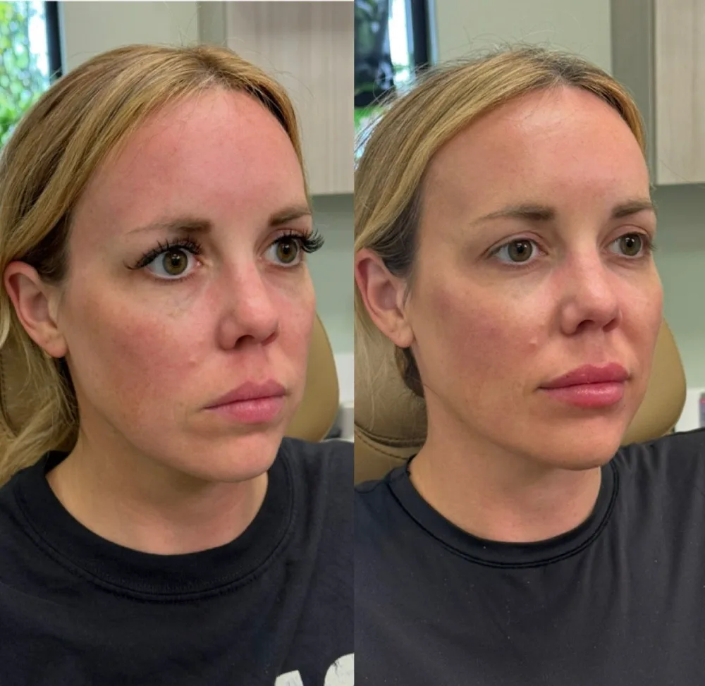 Before and after result following facial injectable treatment at The Aesthetic Company, Canton MI