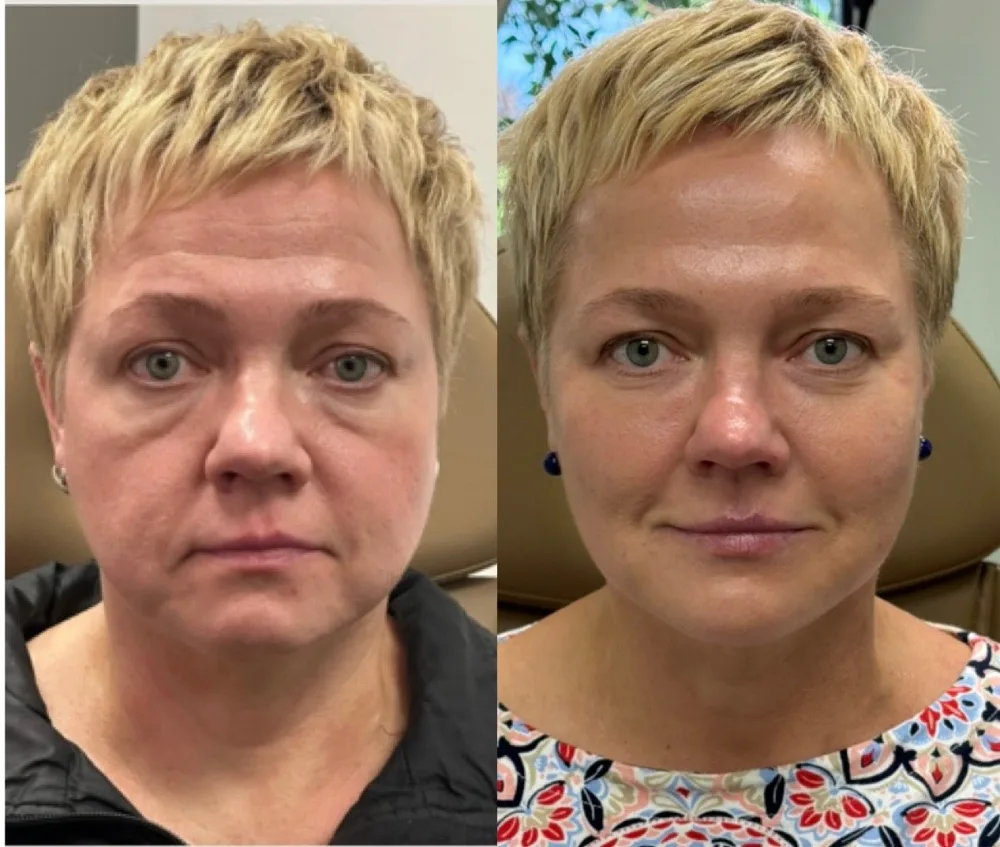 Before and after improvement in skin tone and texture at The Aesthetic Company, Canton MI
