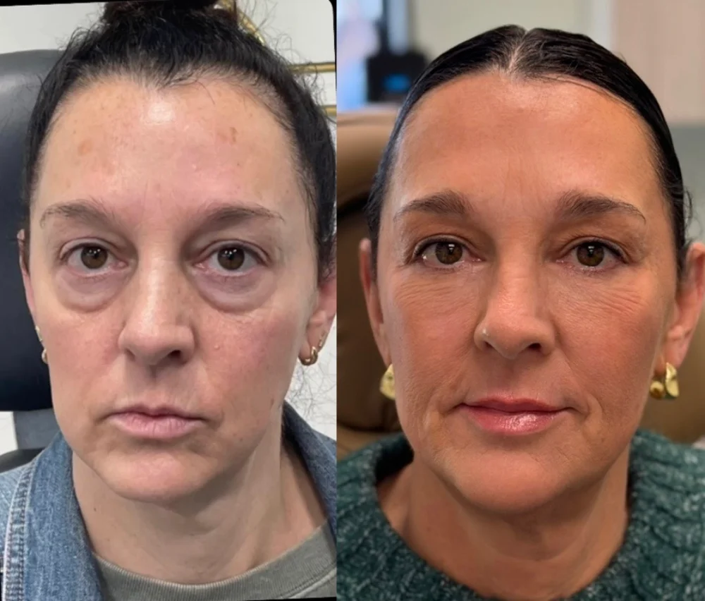 Before and after result following facial rejuvenation treatment at The Aesthetic Company, Canton MI