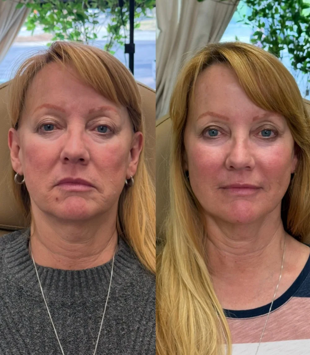 Before and after result following facial balancing with injectables at The Aesthetic Company, Canton MI