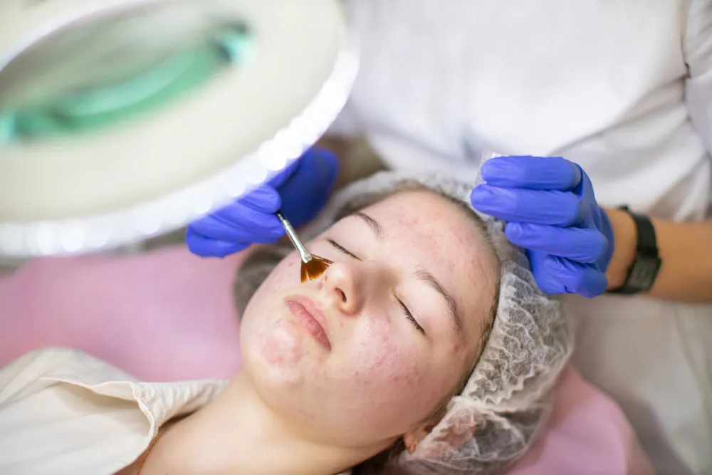 acne treatment Canton Michigan